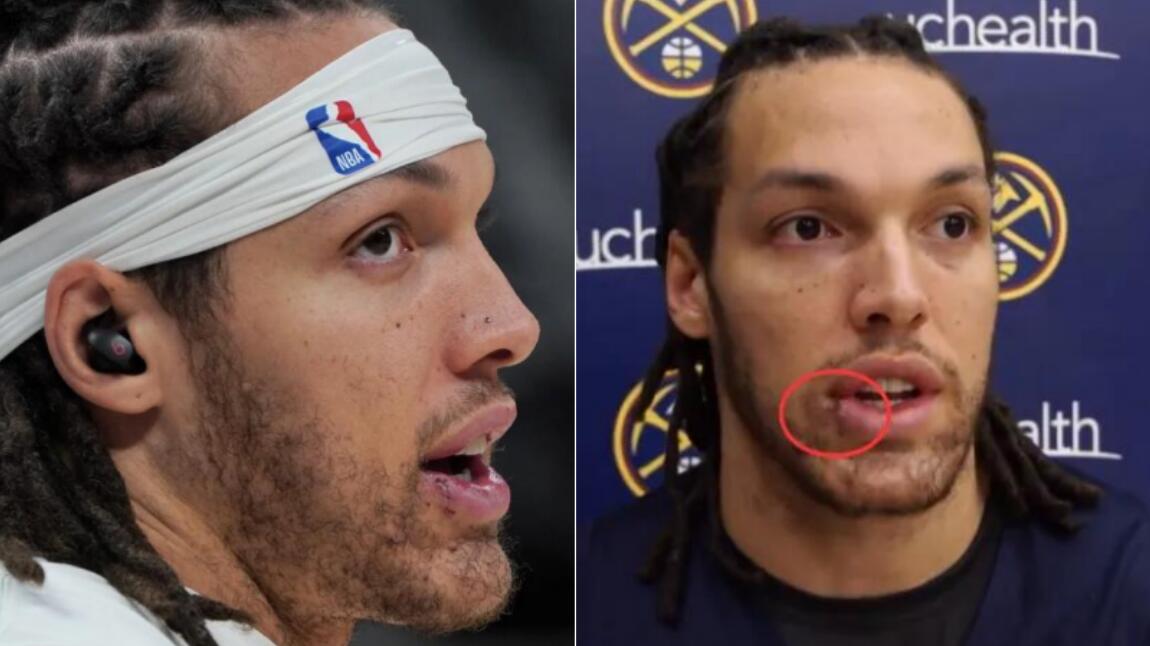 NBA / 戈登被狗咬傷傷口曝光！嘴唇和臉上留下明顯傷疤，直言：不在乎，我不是在選美