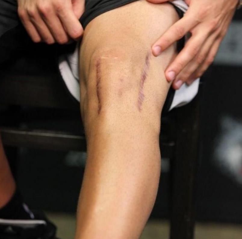 只看傷痕就知道球員有多不容易了！威少臉部凹陷出一個洞，湯普森的傷疤長達15cm！-黑特籃球-NBA新聞影音圖片分享社區